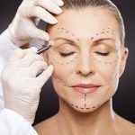 lifting-de-face-cirurgia-plastica-procedimentos-esteticos-giovana-romano-curitiba